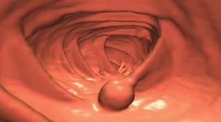Home stool test for colorectal cancer accurate Home stool test for colorectal cancer accurate