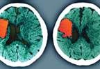 A sibling's stroke hikes risk A sibling's stroke hikes risk