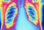 Minimize admissions for heart failure Minimize admissions for heart failure