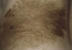 Improving melanoma awareness in men Improving melanoma awareness in men