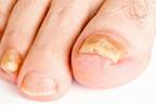 Options for onychomycosis Options for onychomycosis