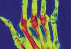 Vitamin D deficiency: Beyond bone health Vitamin D deficiency: Beyond bone health