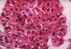 CKD as much of a risk as previous MI? CKD as much of a risk as previous MI?