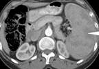 Presyncope coupled with an enlarged spleen suggests infection Presyncope coupled with an enlarged spleen suggests infection