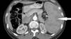 Presyncope coupled with an enlarged spleen suggests infection Presyncope coupled with an enlarged spleen suggests infection