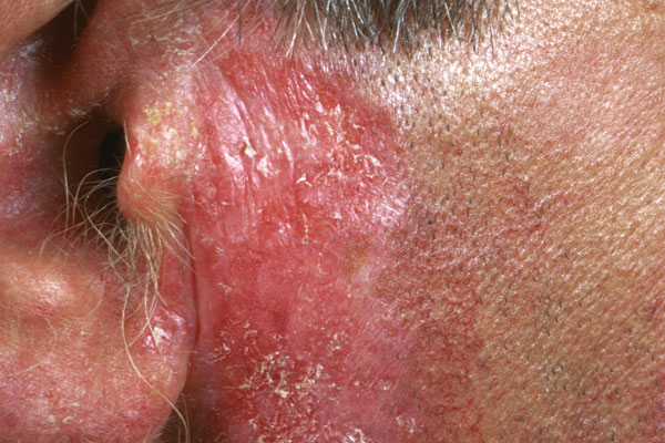 Recognizing systemic lupus erythematosus