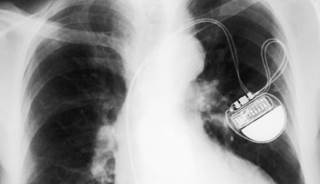 FDA approves new subcutaneous ICD FDA approves new subcutaneous ICD