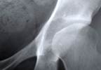 Call to Action Issued to Address Ongoing Osteoporosis Treatment Crisis Call to Action Issued to Address Ongoing Osteoporosis Treatment Crisis