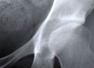Call to Action Issued to Address Ongoing Osteoporosis Treatment Crisis Call to Action Issued to Address Ongoing Osteoporosis Treatment Crisis