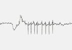 Alzheimer Disease Progression in Patients With MCI Predicted by EEG, Language Deficits Alzheimer Disease Progression in Patients With MCI Predicted by EEG, Language Deficits