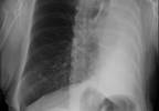 Extreme weight loss in an elderly woman over a 24-month period Extreme weight loss in an elderly woman over a 24-month period