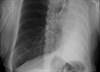 Extreme weight loss in an elderly woman over a 24-month period Extreme weight loss in an elderly woman over a 24-month period