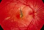 Appropriate eye care lacking for diabetes patients Appropriate eye care lacking for diabetes patients