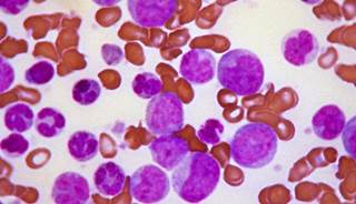 Ponatinib wins early approval for rare leukemias Ponatinib wins early approval for rare leukemias