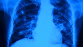 FDA approves Sirturo for MDR-TB FDA approves Sirturo for MDR-TB