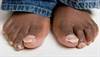 Antifungal therapy in the elderly Antifungal therapy in the elderly