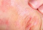 Gluten-free diet or vitamin D supplementation for psoriasis? Gluten-free diet or vitamin D supplementation for psoriasis?