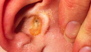 Antibiotic Tx okay for all young kids with AOM Antibiotic Tx okay for all young kids with AOM