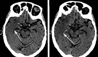 Ipsilesional Neglect Associated with Attentional Bias Ipsilesional Neglect Associated with Attentional Bias