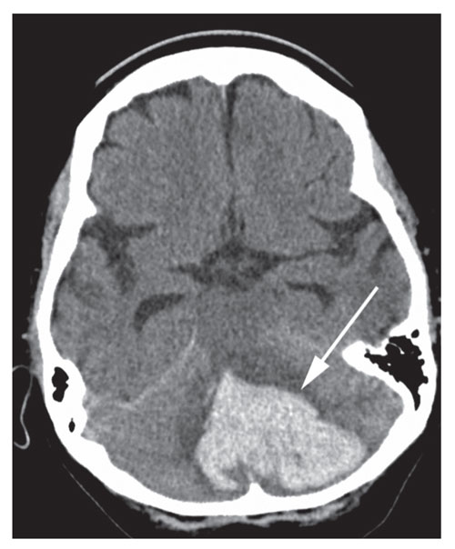 Evaluation and treatment of acute cerebral ischemia - The Clinical Advisor