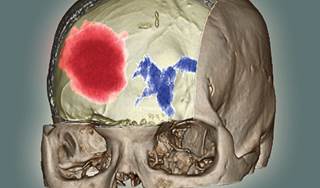 Evaluation and treatment of acute cerebral ischemia Evaluation and treatment of acute cerebral ischemia
