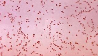 Cephalosporin-resistant gonorrhea emerging in U.S. Cephalosporin-resistant gonorrhea emerging in U.S.