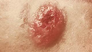 Sexually transmitted secondary, tertiary vaccinia cases reported Sexually transmitted secondary, tertiary vaccinia cases reported