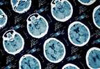 Reducing intracranial pressure after head injury Reducing intracranial pressure after head injury