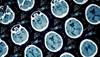 Can Amyloid PET Scans Improve Dementia Outcomes? Can Amyloid PET Scans Improve Dementia Outcomes?