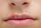 Determining the cause of a refractory lip blister Determining the cause of a refractory lip blister