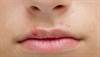 Determining the cause of a refractory lip blister Determining the cause of a refractory lip blister