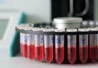 Sexual identity disclosure linked to elevated rates of HIV testing, hepatitis vaccinations Sexual identity disclosure linked to elevated rates of HIV testing, hepatitis vaccinations
