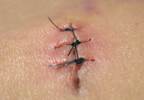 Easing pain during suturing Easing pain during suturing