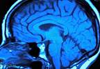 White matter integrity may indicate cognitive impairment in MS White matter integrity may indicate cognitive impairment in MS