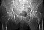 Stopping medications before knee or hip surgery Stopping medications before knee or hip surgery