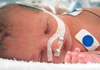 Surfactant cuts ventilation needs in preterm infants Surfactant cuts ventilation needs in preterm infants
