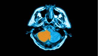 Recent infection ups pediatric stroke risk Recent infection ups pediatric stroke risk