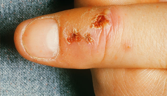 blisters-on-fingers-herpes-small-blisters-on-fingers-pictures