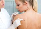 Fewer moles linked to more aggressive melanoma Fewer moles linked to more aggressive melanoma