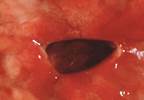 Clinical evaluation of
peptic ulcer disease Clinical evaluation of
peptic ulcer disease
