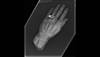 Accidental hand amputation requires extensive surgery Accidental hand amputation requires extensive surgery