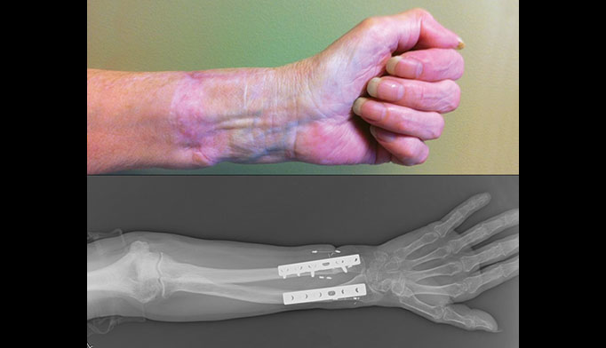 Surgical Procedure After An Accidental Hand Amputation