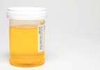 How is microalbumin:creatinine ratio interpreted? How is microalbumin:creatinine ratio interpreted?