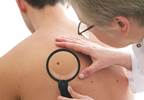 Melanoma diagnostic criteria not accurate for kids Melanoma diagnostic criteria not accurate for kids