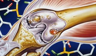 Not all placebos are equally effective for knee osteoarthritis. Not all placebos are equally effective for knee osteoarthritis.