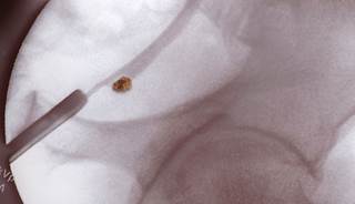 Kidney stones linked to heart disease in women Kidney stones linked to heart disease in women