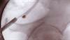 Kidney stones linked to heart disease in women Kidney stones linked to heart disease in women