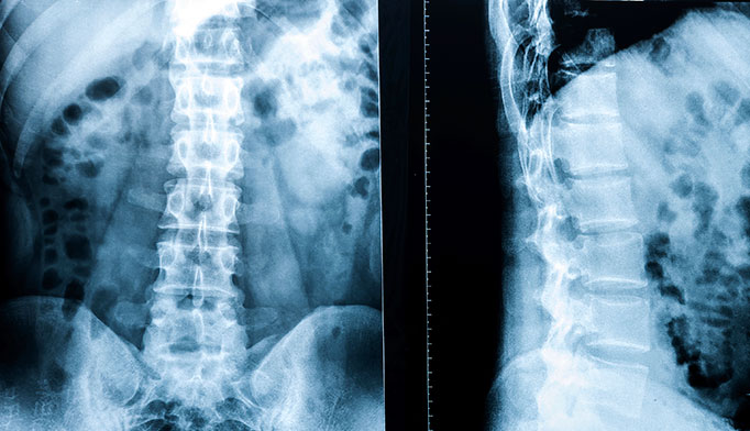 Spinal Radiosurgery Ups Vertebral Fracture Risk The Clinical Advisor