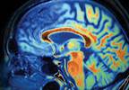 Celexa cuts Alzheimer's agitation, but safety questionable Celexa cuts Alzheimer's agitation, but safety questionable