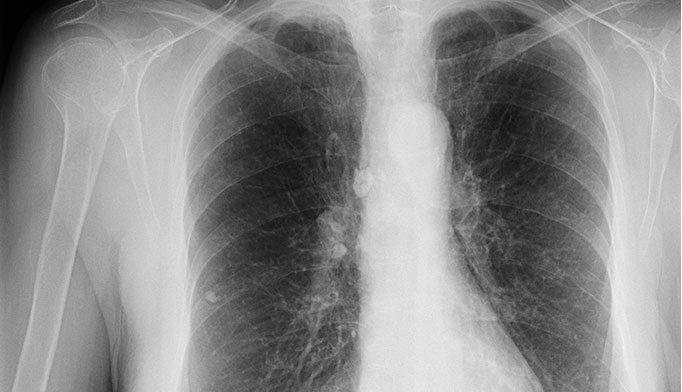 healthy lung xray